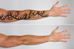 Laser Tattoo Removal